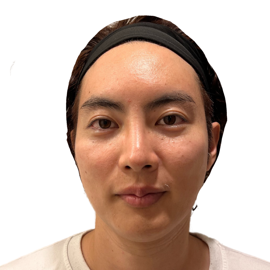 マヌカフェイシャル（ダーマペン4）